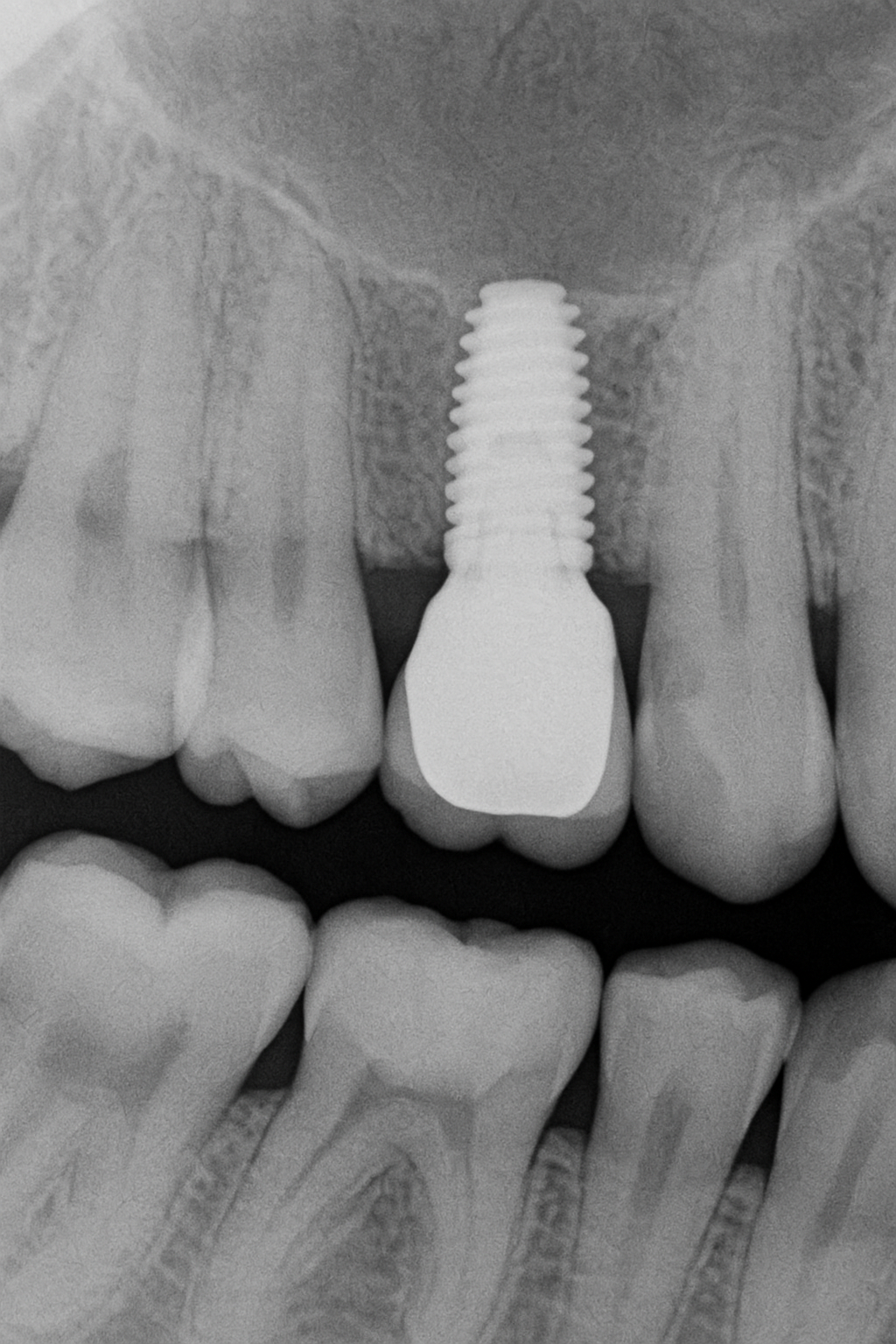 Resultado estético y funcional de implantes dentales